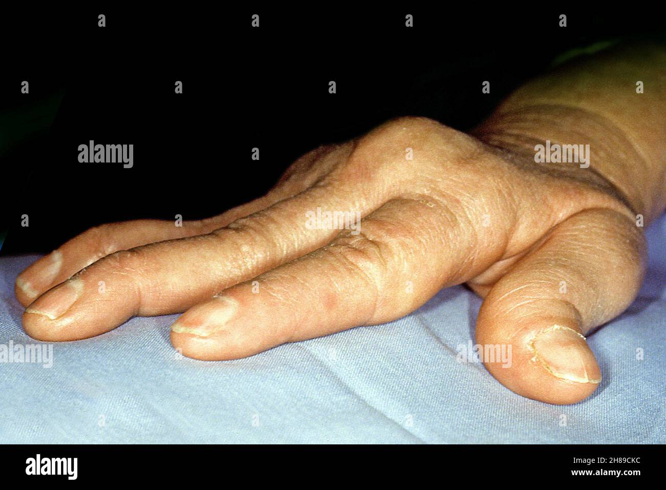 Rheumatoid arthritis Stock Photo