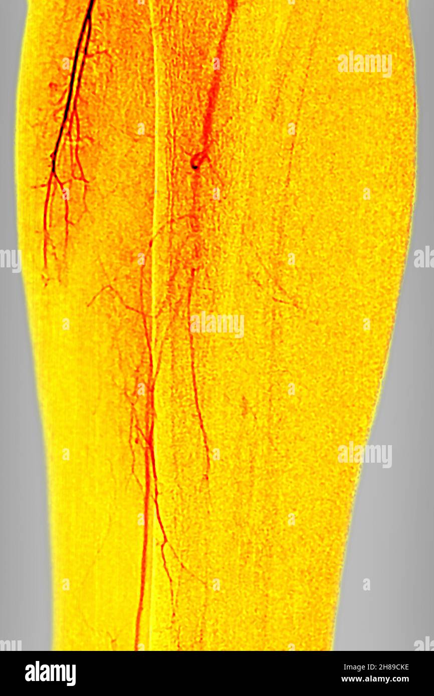 Arteritis of the lower limbs Stock Photo
