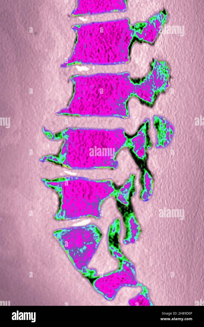 Lumbar degenerative disc disease Stock Photo - Alamy