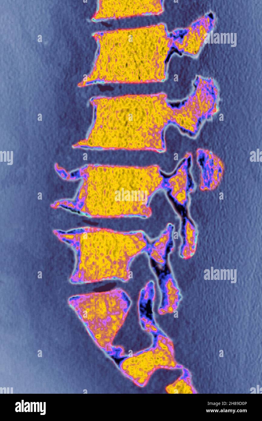 Lumbar degenerative disc disease Stock Photo Alamy