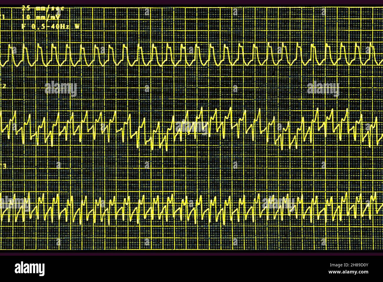 Atrial tachycardia Stock Photo