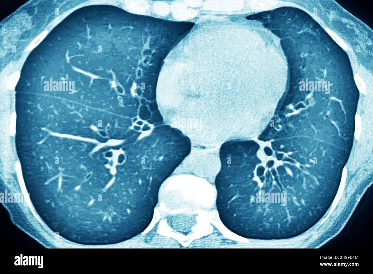 Cystic fibrosis Stock Photo