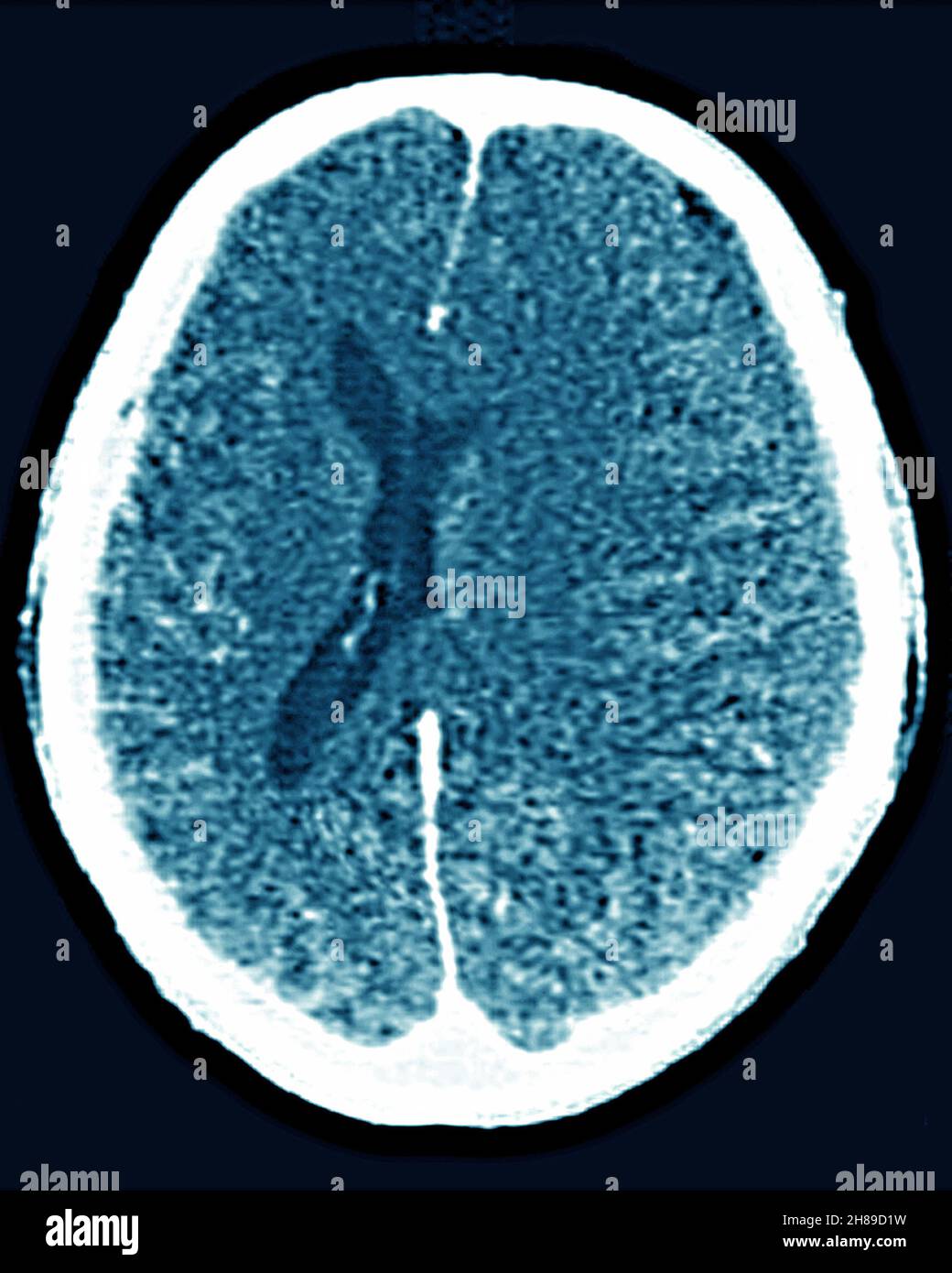 Cerebral edema Stock Photo