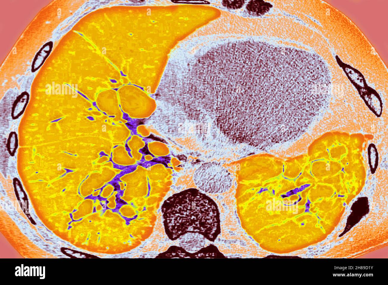 Cystic fibrosis Stock Photo