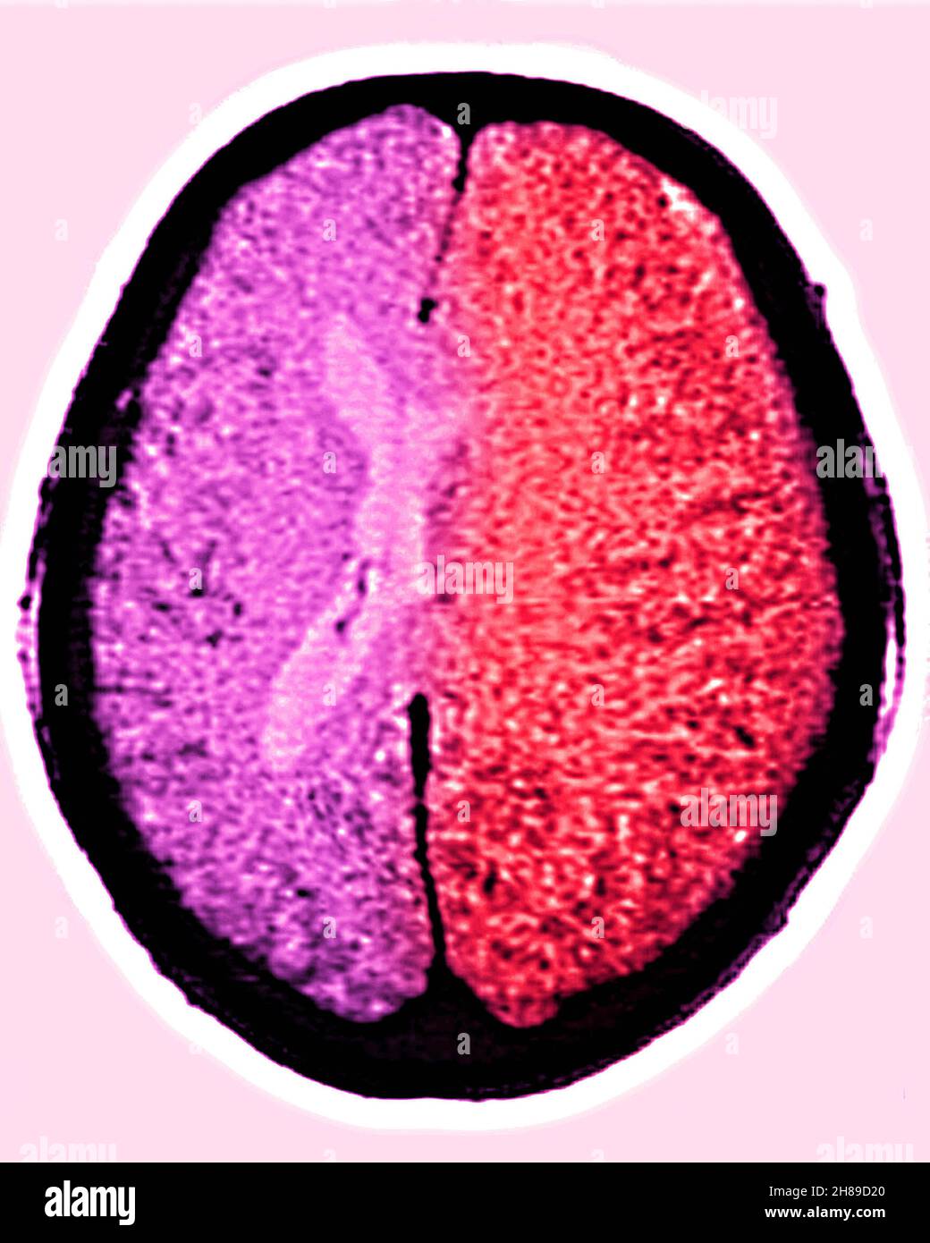 Cerebral edema Stock Photo