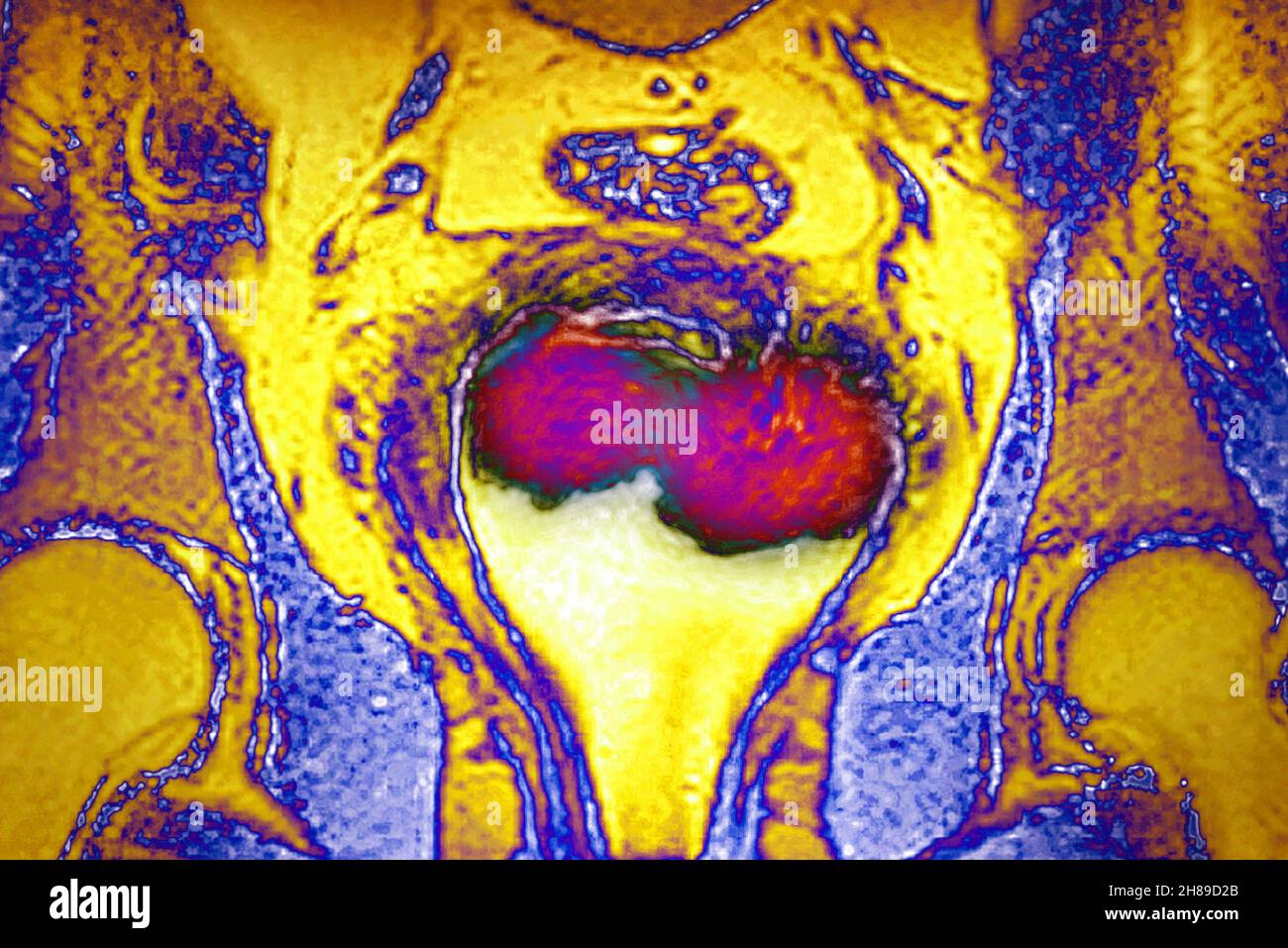 Uterus cancer Stock Photo