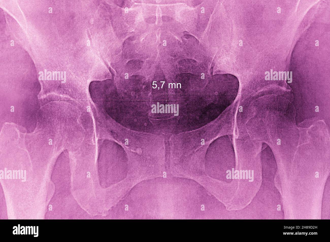 Hip asymmetry Stock Photo
