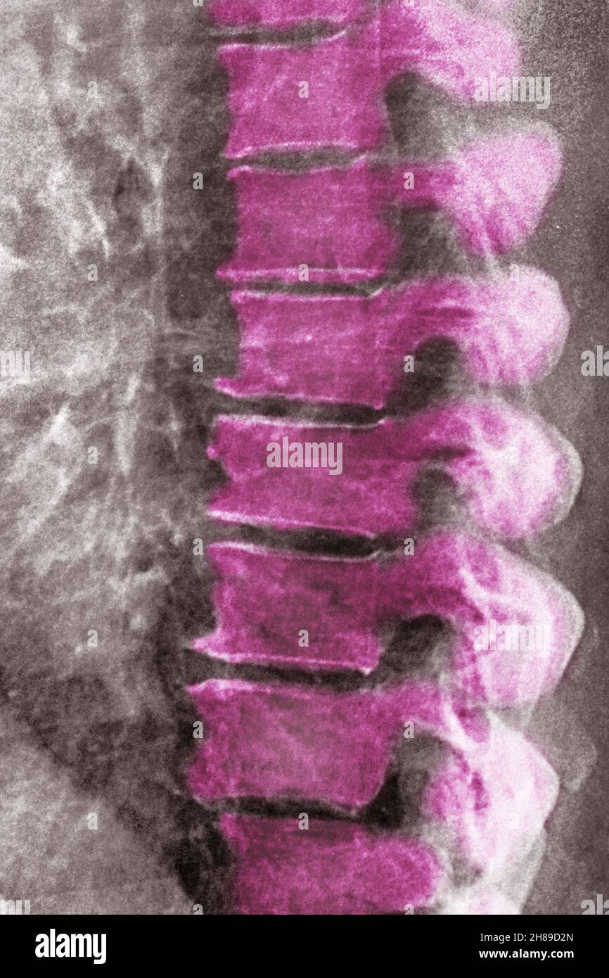 Lumbar degenerative disc disease Stock Photo Alamy