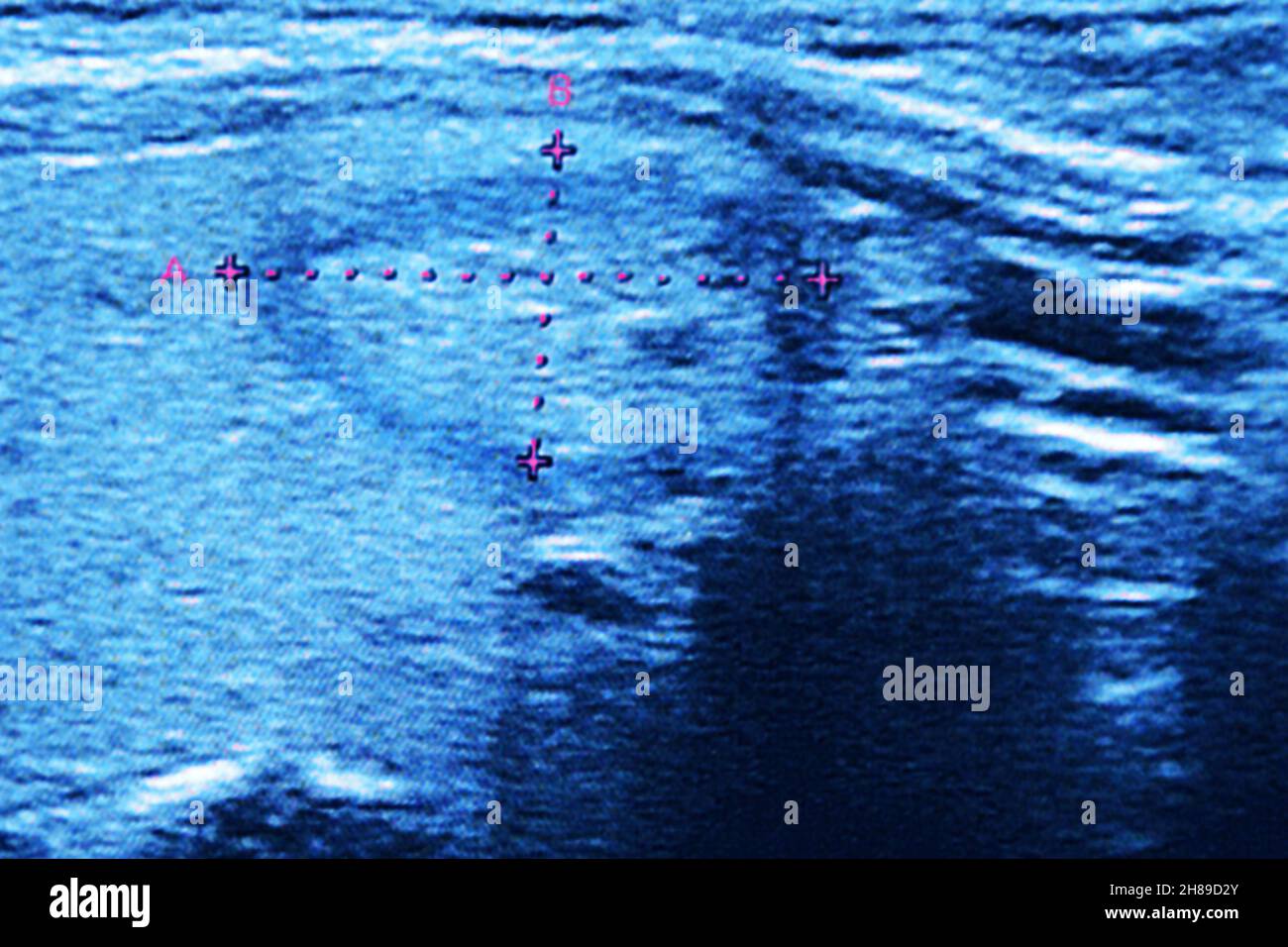 Nodular thyroid tumor. Stock Photo