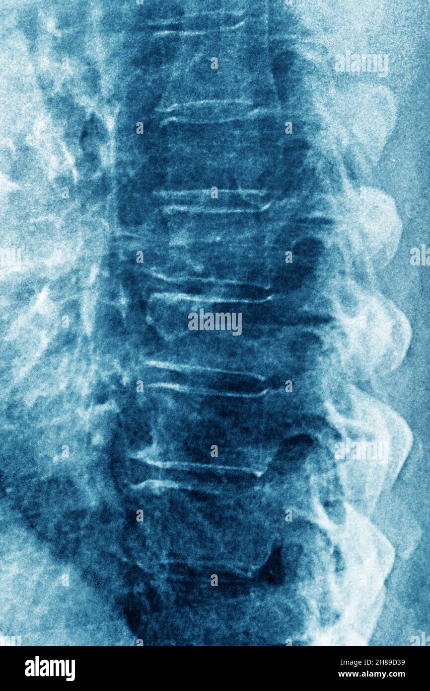 Lumbar degenerative disc disease Stock Photo Alamy
