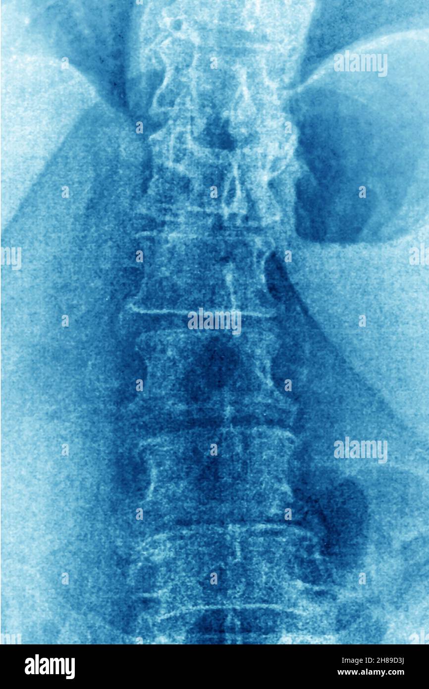 Lumbar degenerative disc disease Stock Photo - Alamy