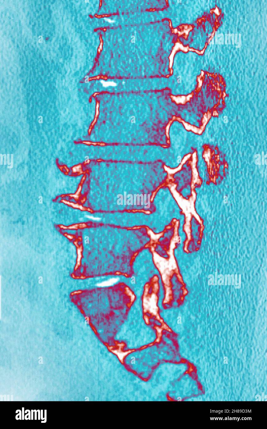 Lumbar degenerative disc disease Stock Photo Alamy