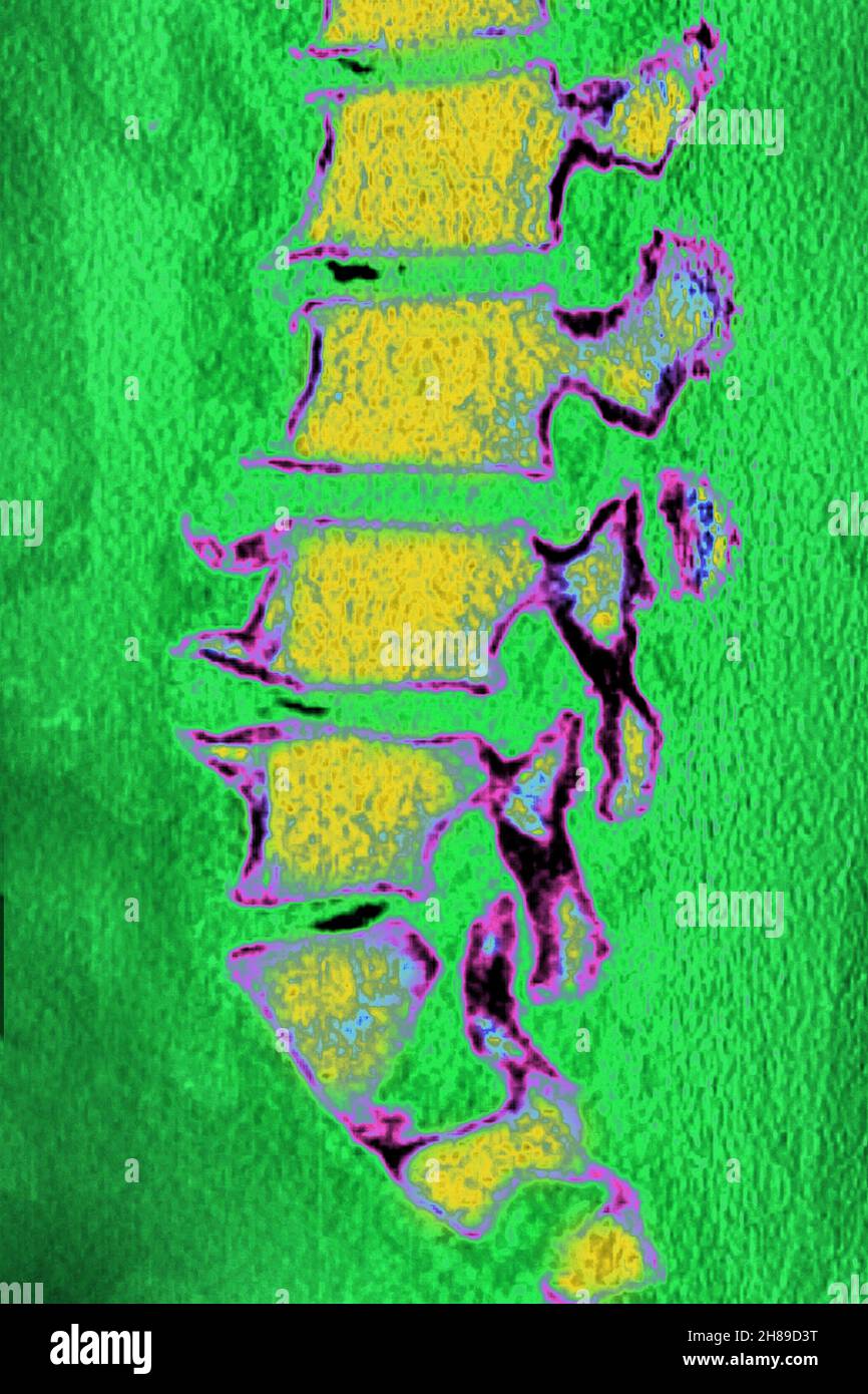 Lumbar degenerative disc disease Stock Photo Alamy