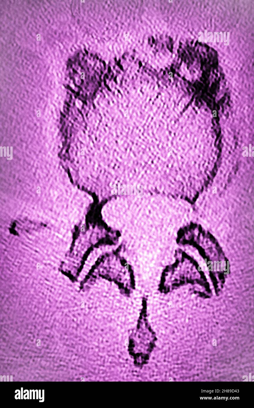 Lumbar degenerative disc disease Stock Photo Alamy