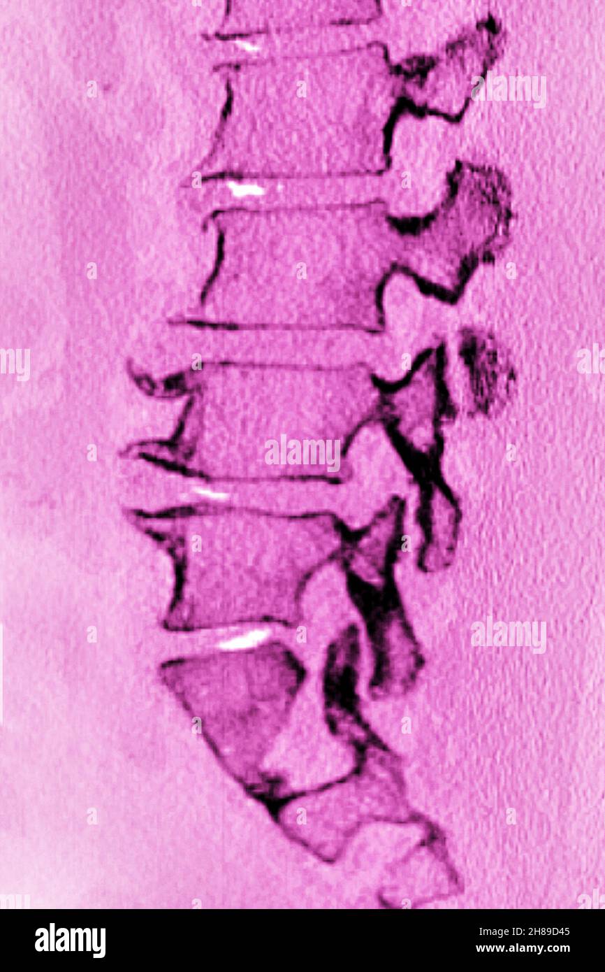 Lumbar degenerative disc disease Stock Photo Alamy