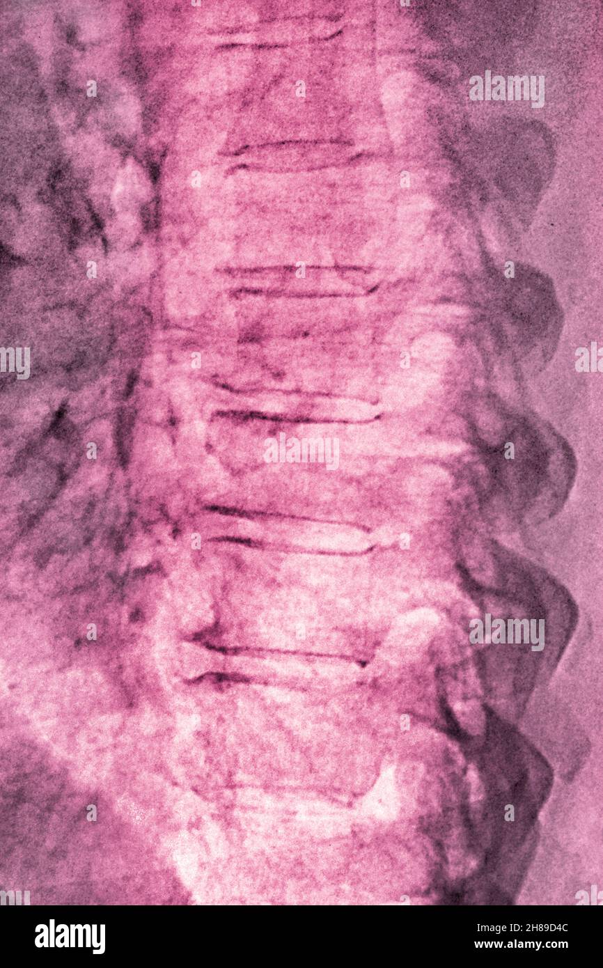 Lumbar degenerative disc disease Stock Photo Alamy