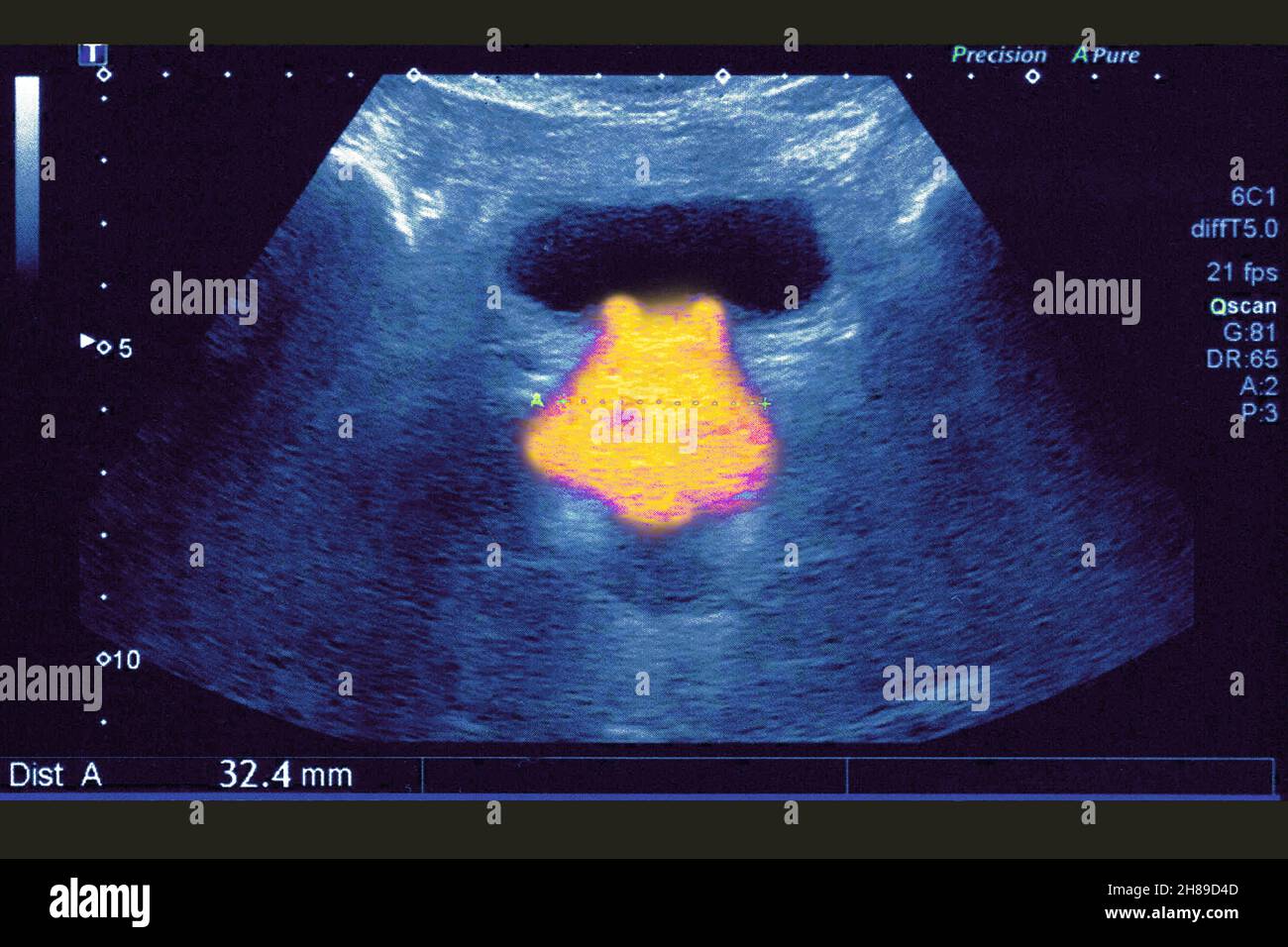 Prostate ultrasound Stock Photo Alamy