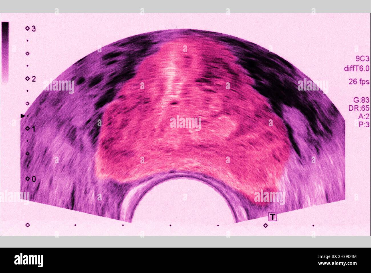 Prostate ultrasound Stock Photo
