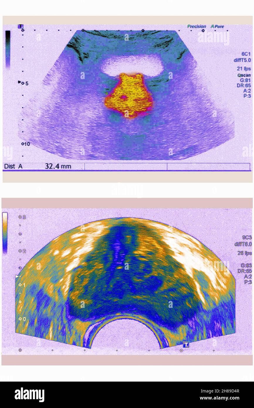 Prostate ultrasound Stock Photo