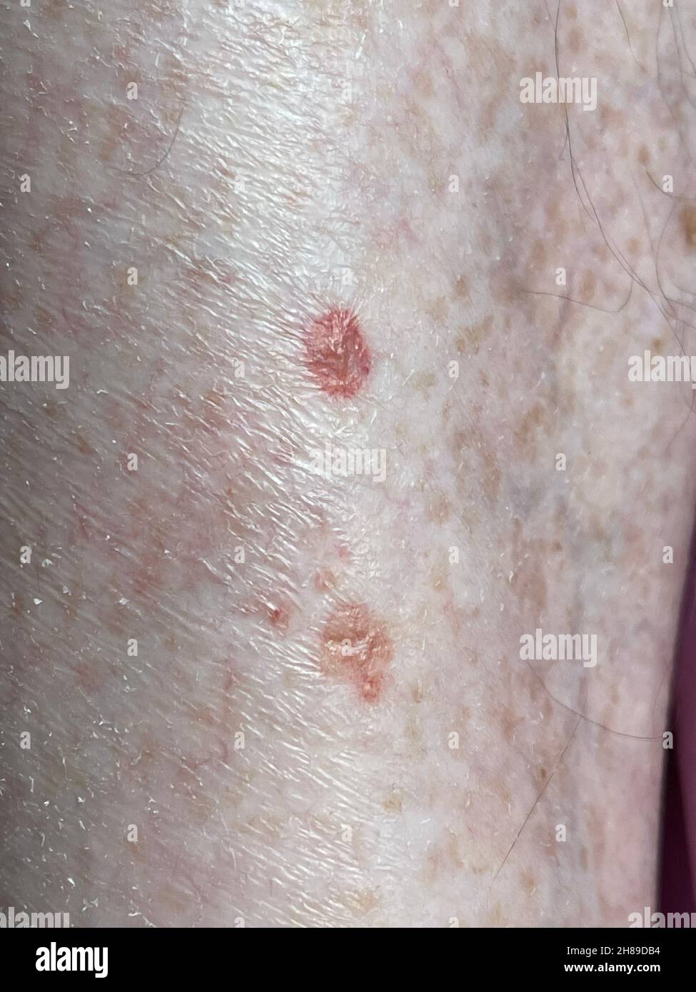 Psoriasis material hi-res stock photography and images - Alamy