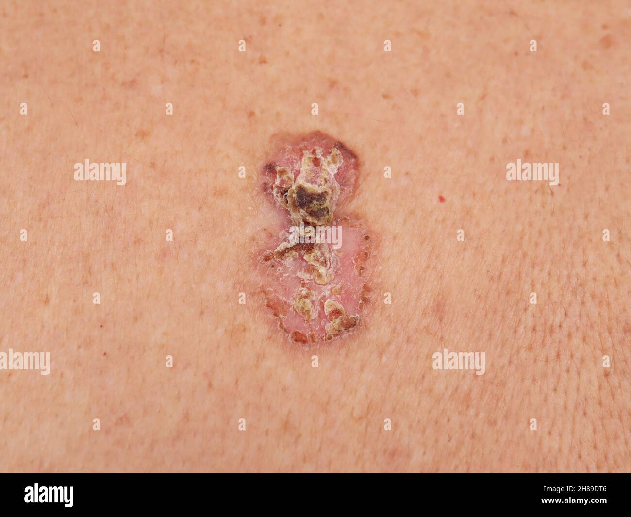 Nodular basal cell carcinoma Stock Photo