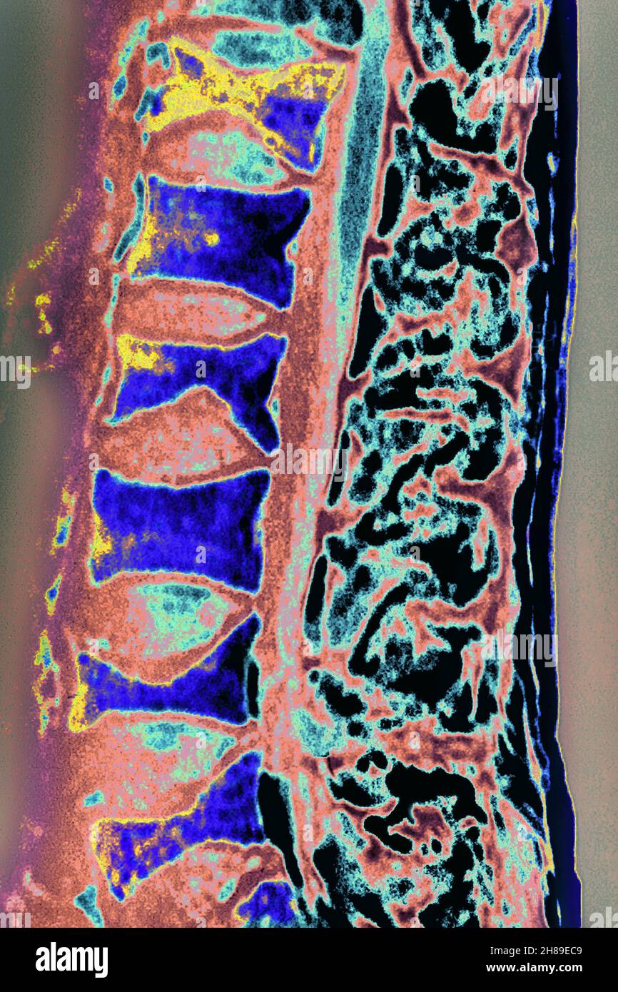 Image of lumbar spine hi-res stock photography and images - Alamy