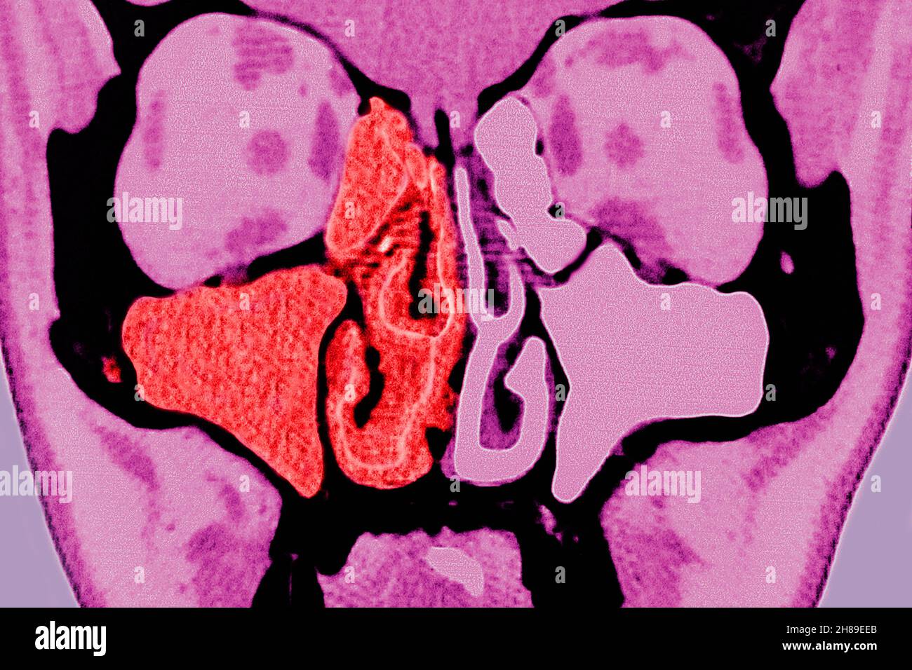 Sinusitis Stock Photo