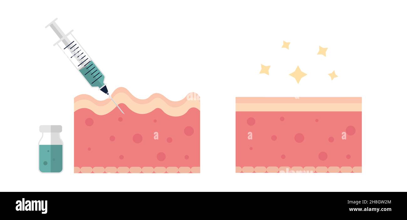 Skin with wrinkles and fine lines before and after injection