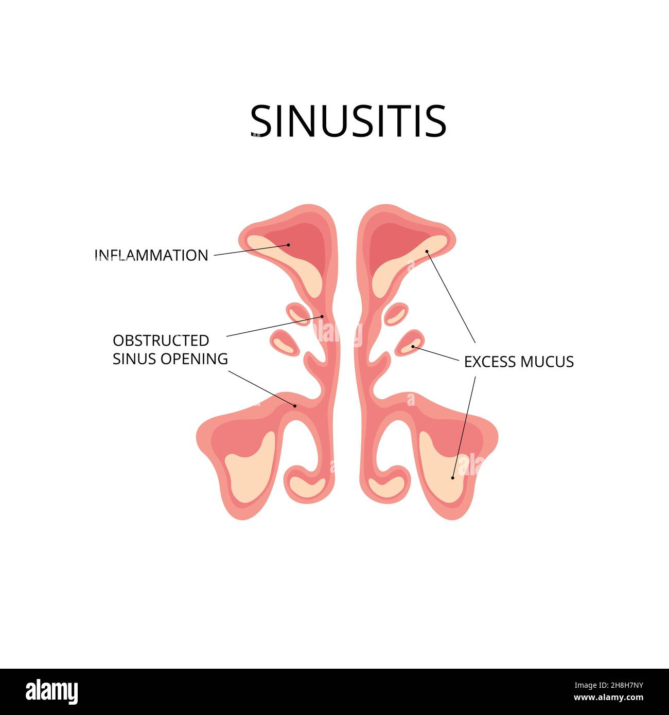 Inflammated sinus with excess mucus and obstrusted sinus openings. Infection, nasal disease, anatomy. Ffor topics like diagnosis, congestion Stock Vector
