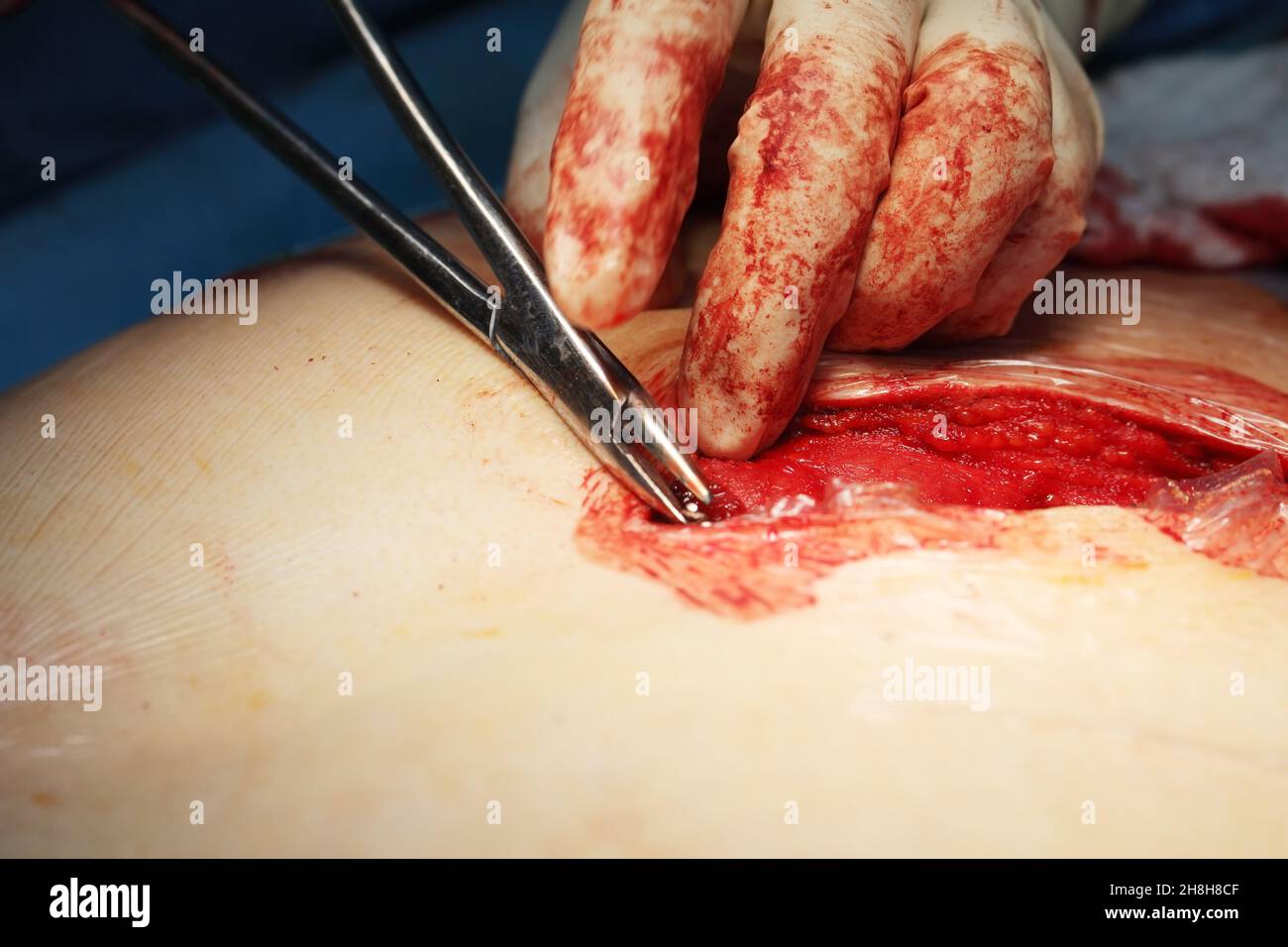 Surgeon with hand tool treats the deep injury of patient. Stock Photo
