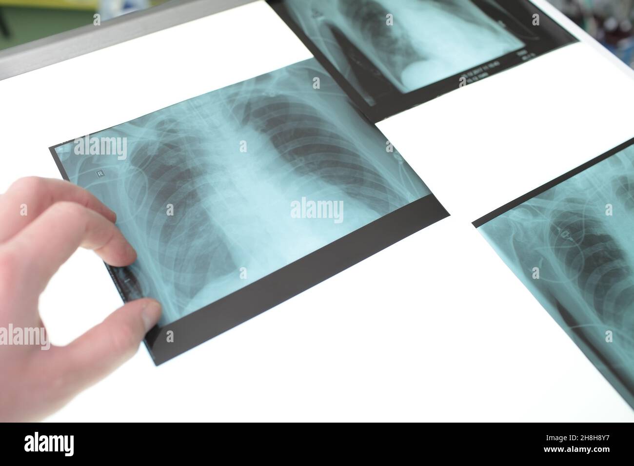 Series of X-ray images on X-ray viewer in the staffroom. Stock Photo