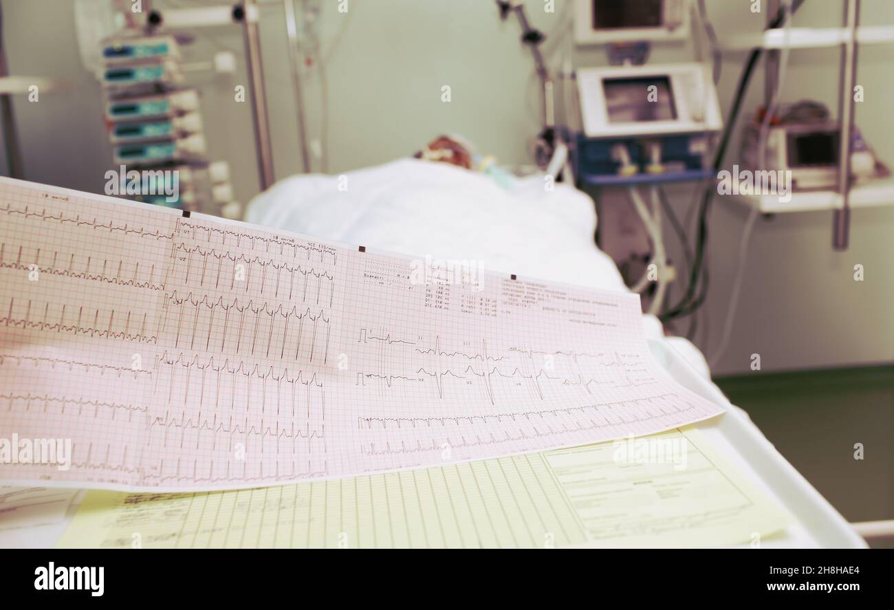 ECG of the patient in serious condition in the ICU. Stock Photo