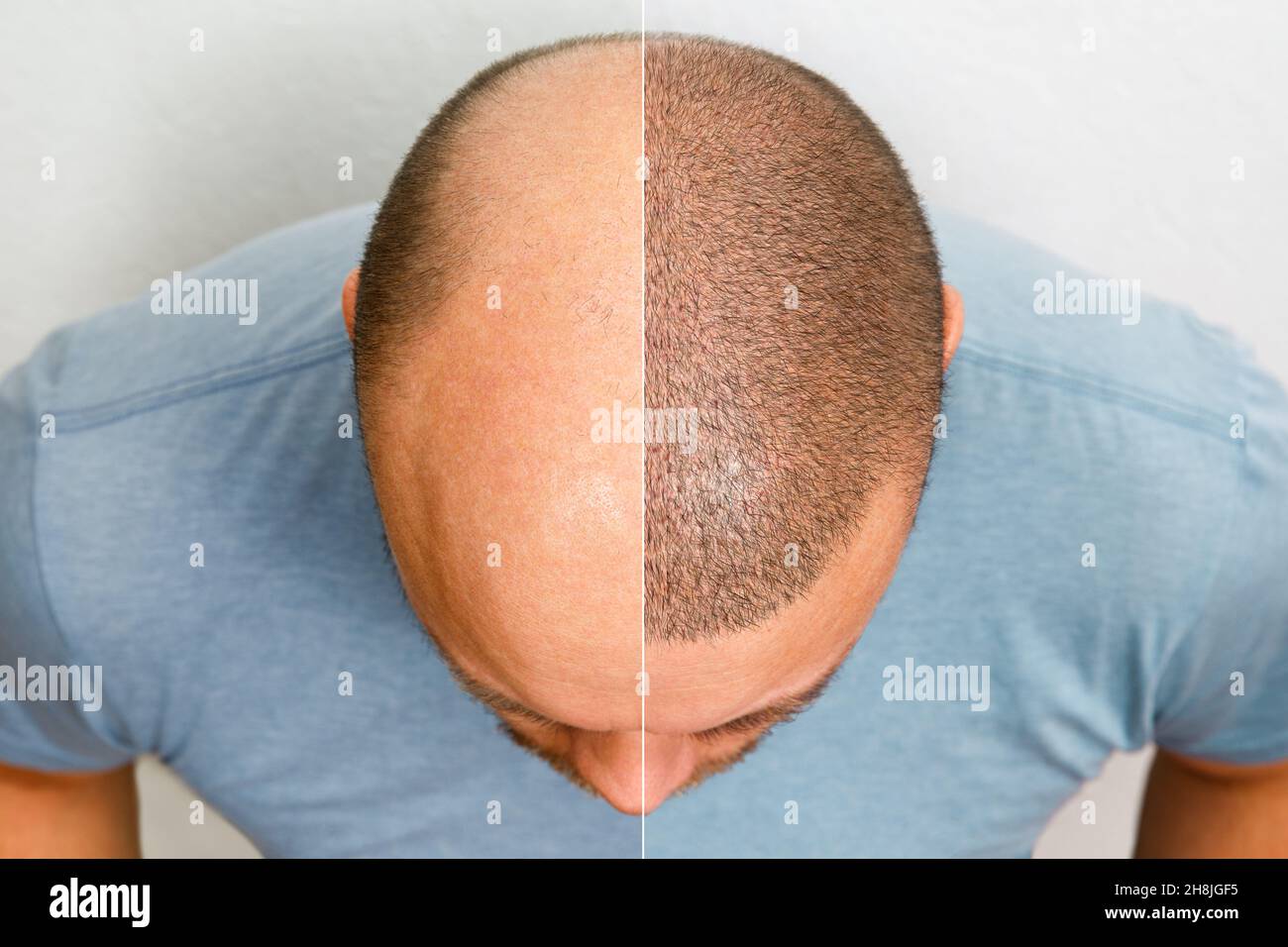 The head of a balding man before and after hair transplant surgery. A man losing his hair has become shaggy. An advertising poster for a hair Stock Photo