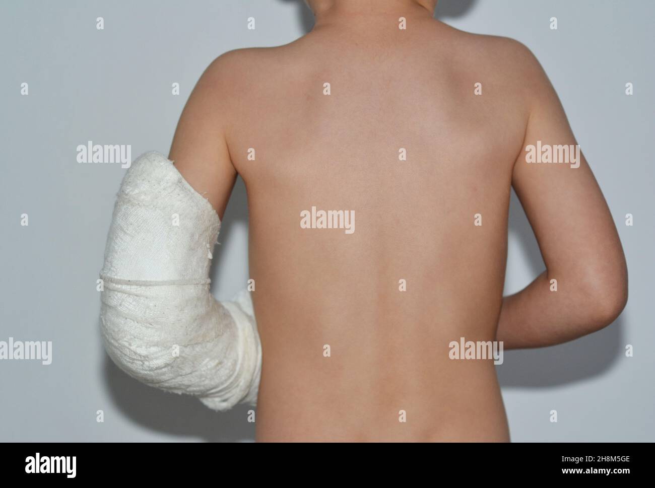 Child's back of a four year old boy with a broken arm in cast. A little boy with a cast to heal the broken bone in the arm. Stock Photo