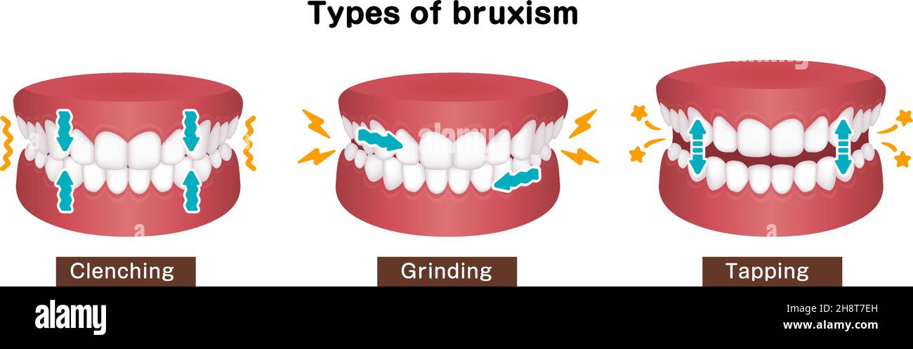 Types of bruxism (teeth grinding) vector illustration Stock Vector