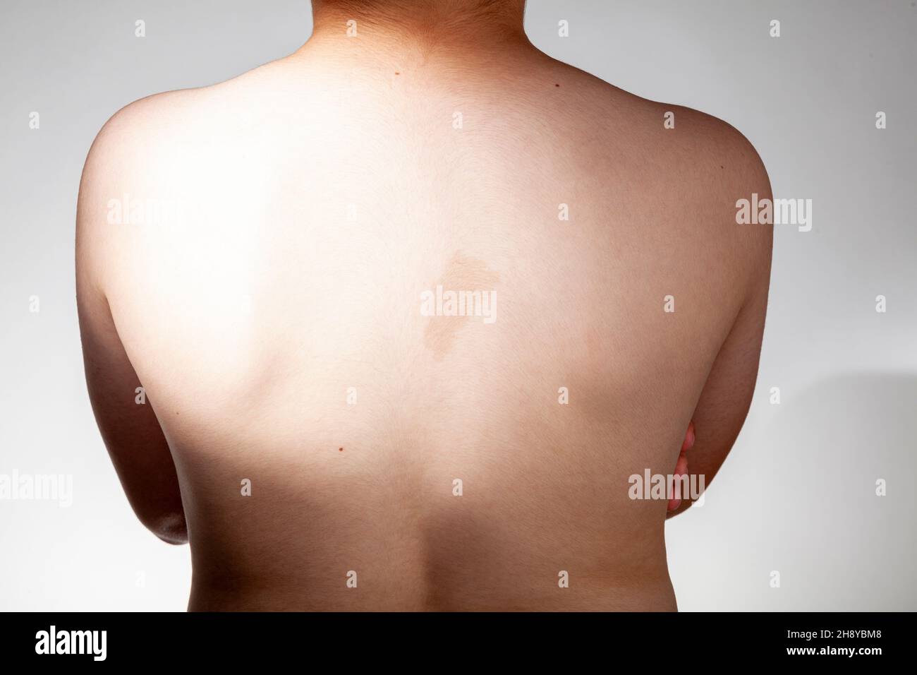 A large light brown cafe au lait spot known as birth mark on the inter scapular region of a caucasian male. This benign skin discoloration may be rela Stock Photo