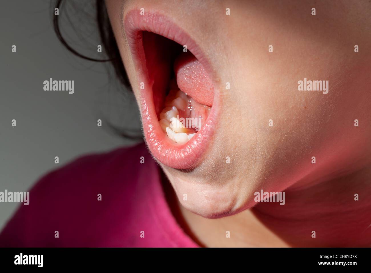 Orthodontic treatment concept image with a small girl showing her mouth. Misaligned teeth due to crowding in the lower jaw makes her a prime candidate Stock Photo