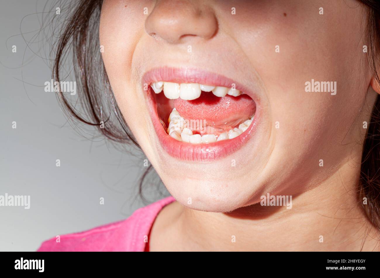 A caucasian girl with teeth crowding is showing the inside of her mouth in a dentist exam room. One of the front incisors are misaligned causing probl Stock Photo