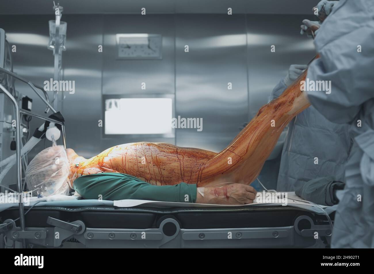 Sleeping patient on the surgical table and working surgeons in the modern operating theatre. Stock Photo