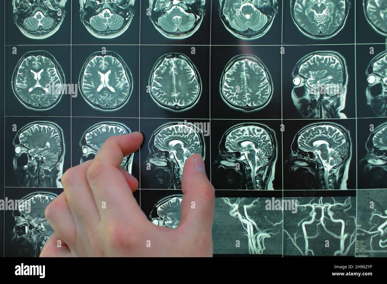 Doctors hand pointing to mri image. Stock Photo