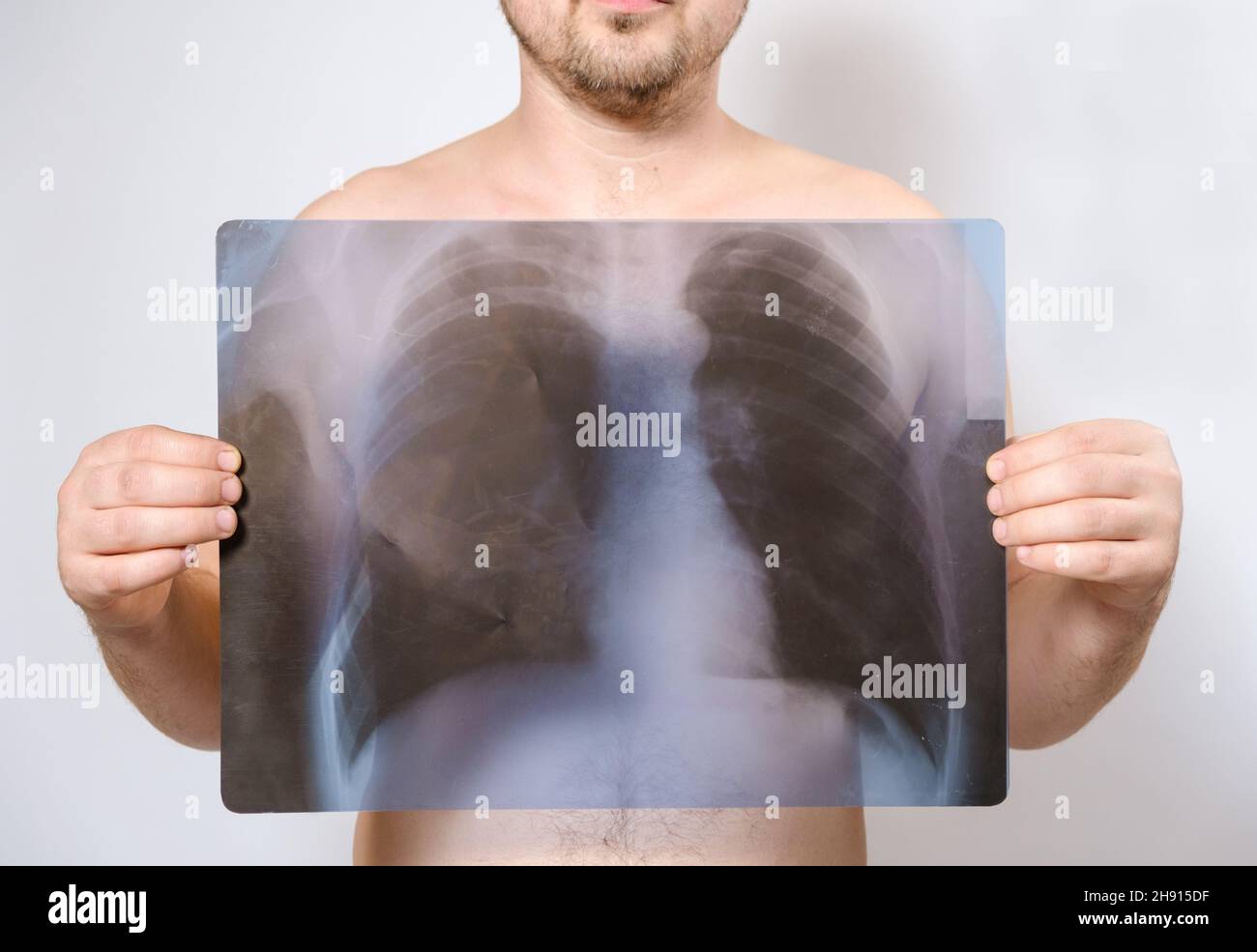 Chest x ray near me hires stock photography and images Alamy