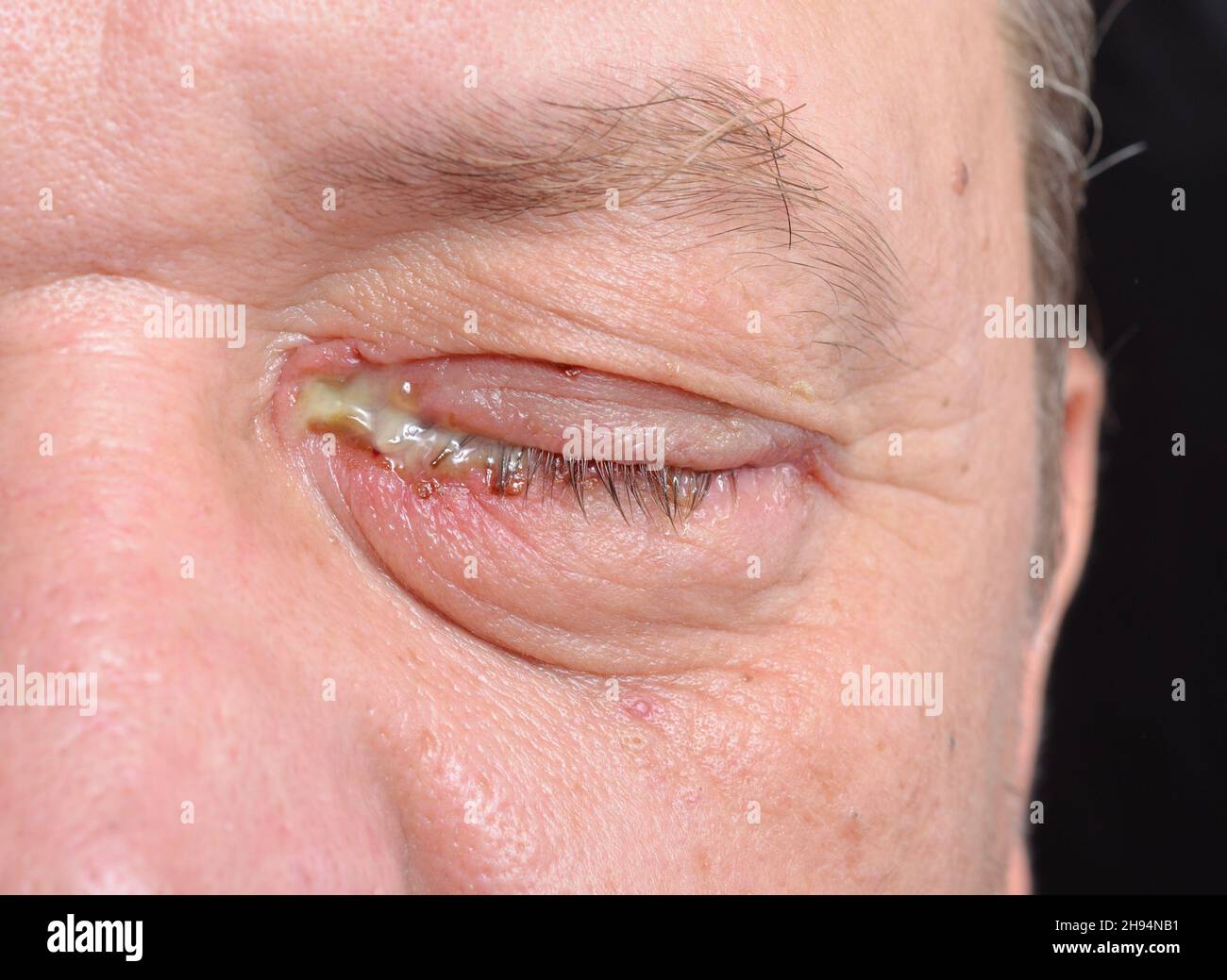 Purulent Eye Rash An eye with bacterial purulence conjunctivitis, also known as pink eye ...