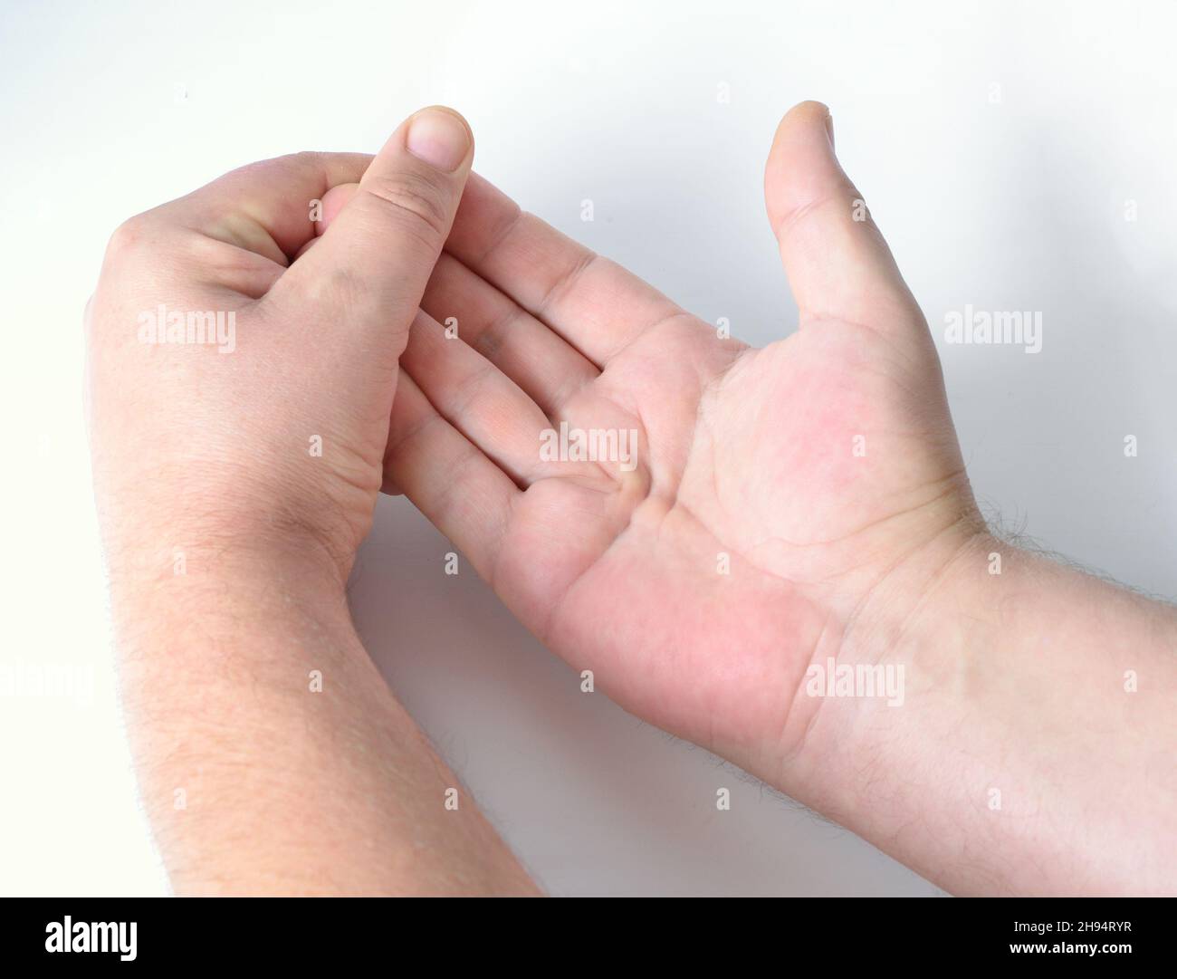 Dupuytren's contracture, also called Dupuytren's disease, Morbus Dupuytren, Viking disease, and Celtic hand. Inspection. Stock Photo