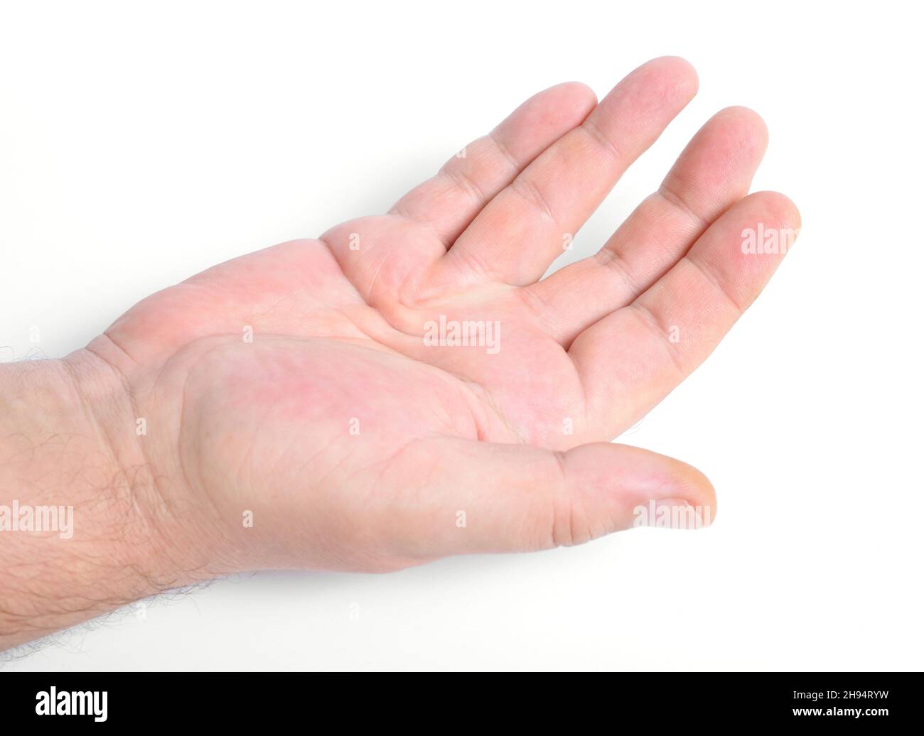 Dupuytren's contracture, also called Dupuytren's disease, Morbus Dupuytren, Viking disease, and Celtic hand. On white background. Stock Photo