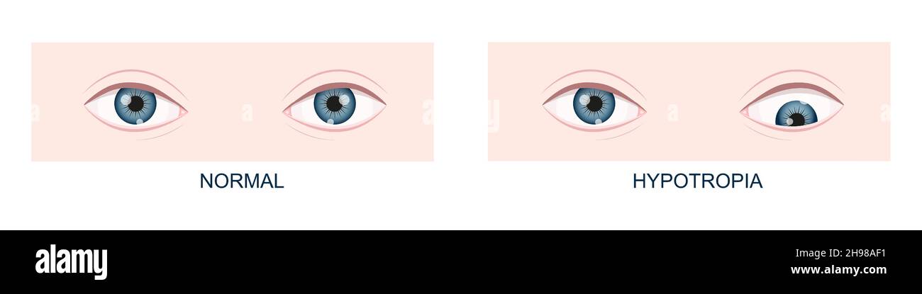 Hypotropia. Vertical strabismus. Human eyes healthy and with downward gaze  position. Double vision. Vector cartoon illustration Stock Vector Image &  Art - Alamy