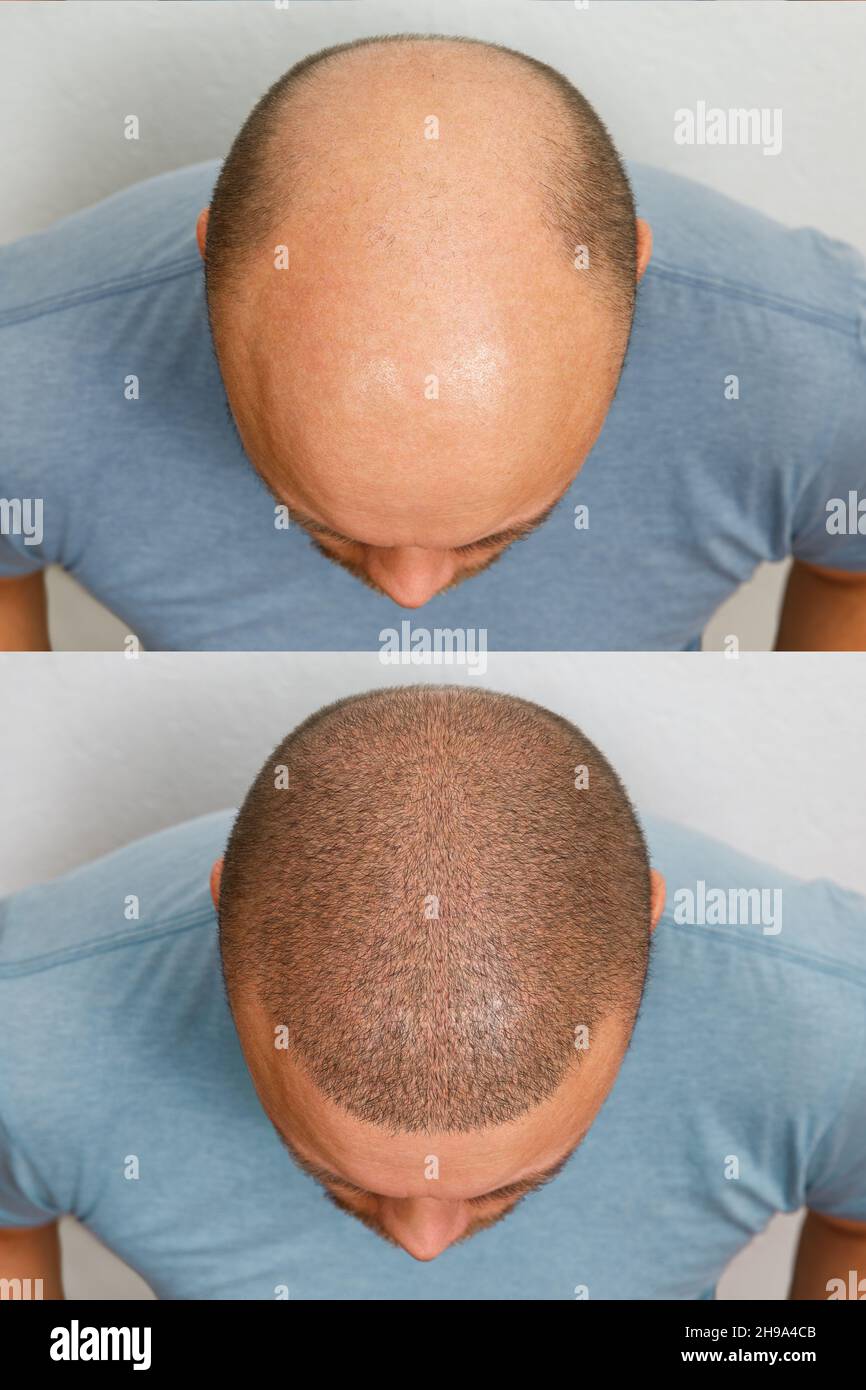 The head of a balding man before and after hair transplant surgery. A man  losing his hair has become shaggy. An advertising poster for a hair Stock  Photo - Alamy