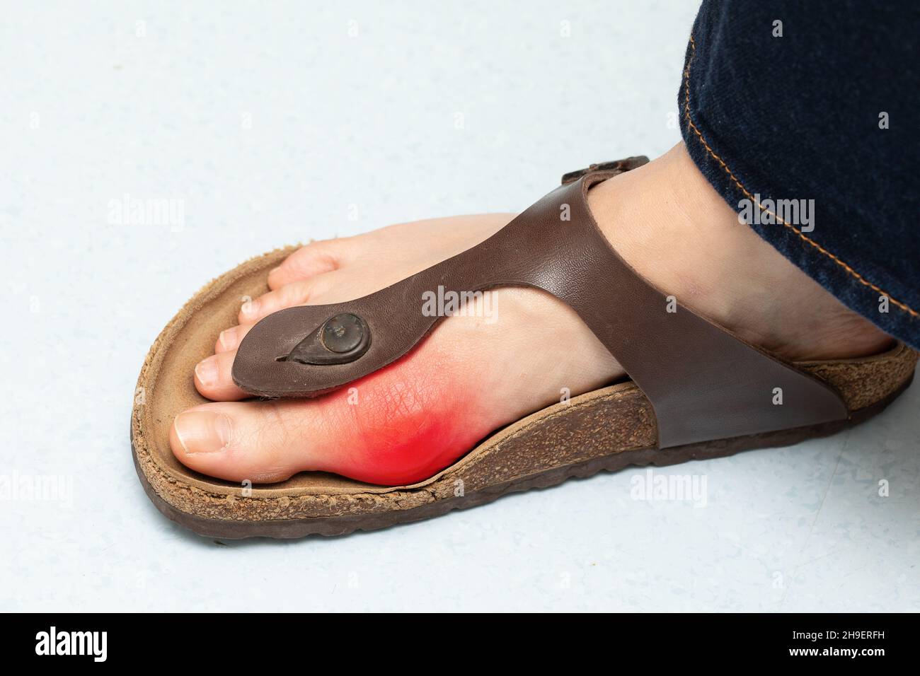 Foot deformation hi-res stock photography and images - Alamy