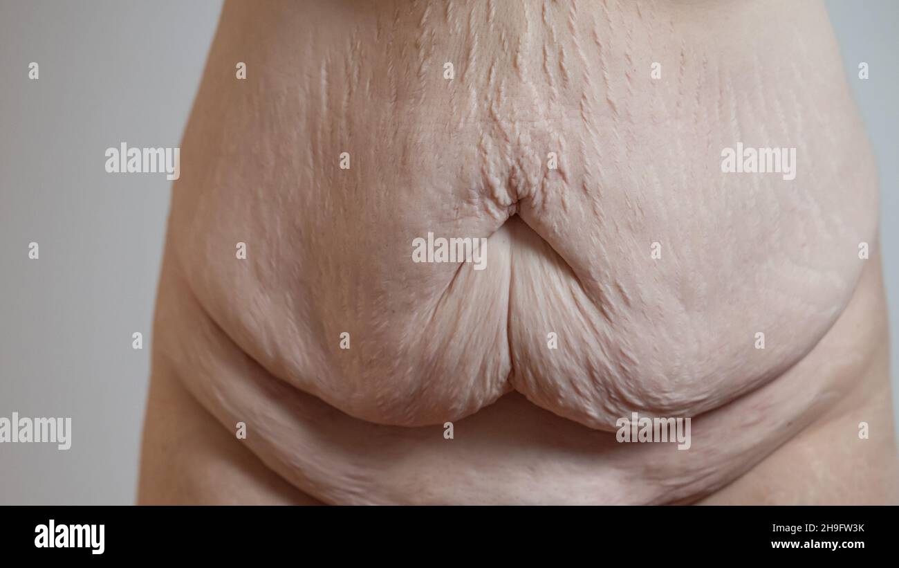 Saggy skin after loosing serious weight on belly or abdomen area of a body. Visible flabby skin on tummy and around bellybutton. Stock Photo