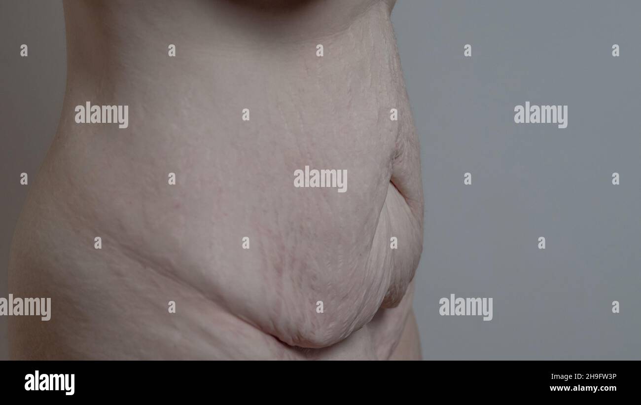 Saggy skin after loosing serious weight on belly or abdomen area of a body. Visible flabby skin on tummy and around bellybutton. Stock Photo