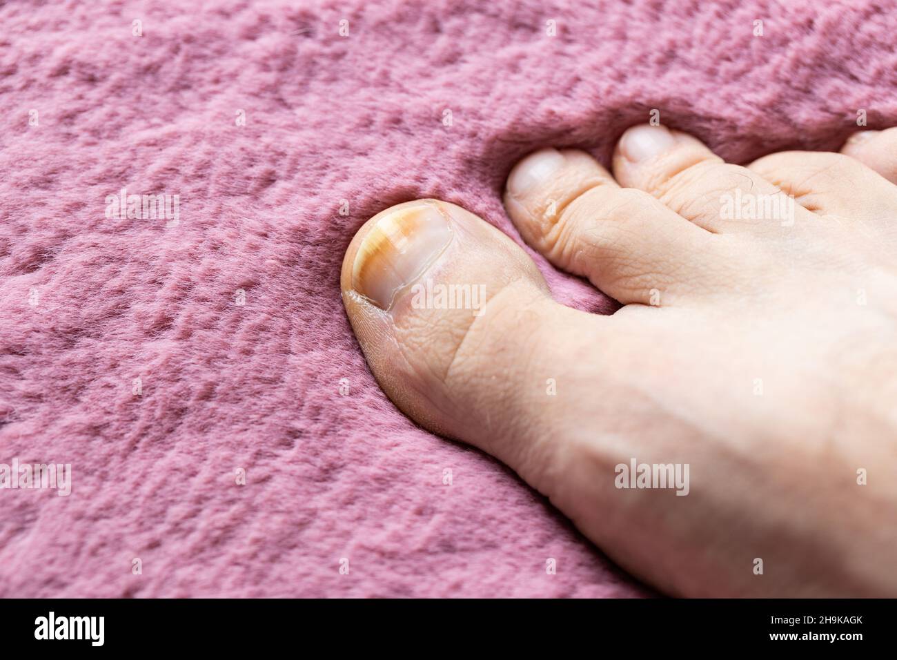 onychomycosis, the initial stage of ringworm. Big toe infected with fungal bacteria, Background pacific pink Stock Photo